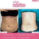 รีวิวดูดไขมัน-หมอเป๊ก-NYC Clinic-10