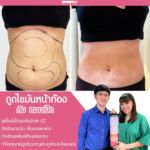 รีวิวดูดไขมัน-หมอเป๊ก-NYC Clinic-09