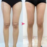 รีวิวดูดไขมัน-หมอเป๊ก-NYC Clinic-08