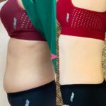 รีวิวดูดไขมัน-หมอเป๊ก-NYC Clinic-07