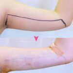 รีวิวดูดไขมัน-หมอเป๊ก-NYC Clinic-06