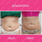 รีวิวดูดไขมัน-หมอเป๊ก-NYC Clinic-03