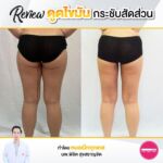 รีวิวดูดไขมัน-หมอเป๊ก-NYC Clinic-45