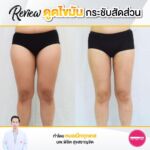 รีวิวดูดไขมัน-หมอเป๊ก-NYC Clinic-44