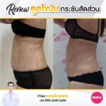 รีวิวดูดไขมัน-หมอเป๊ก-NYC Clinic-43