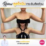 รีวิวดูดไขมัน-หมอเป๊ก-NYC Clinic-41